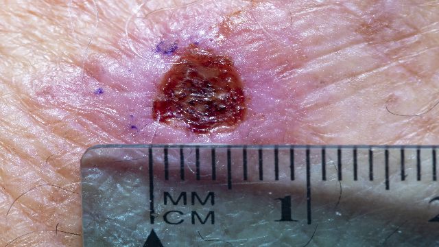 Incisional biopsy cite on male hand